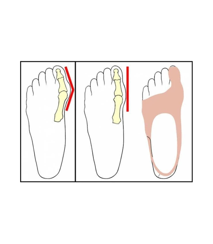 ORIONE OK PED CORRETTORE DIURNO PER ALLUCE VALGO ART 228